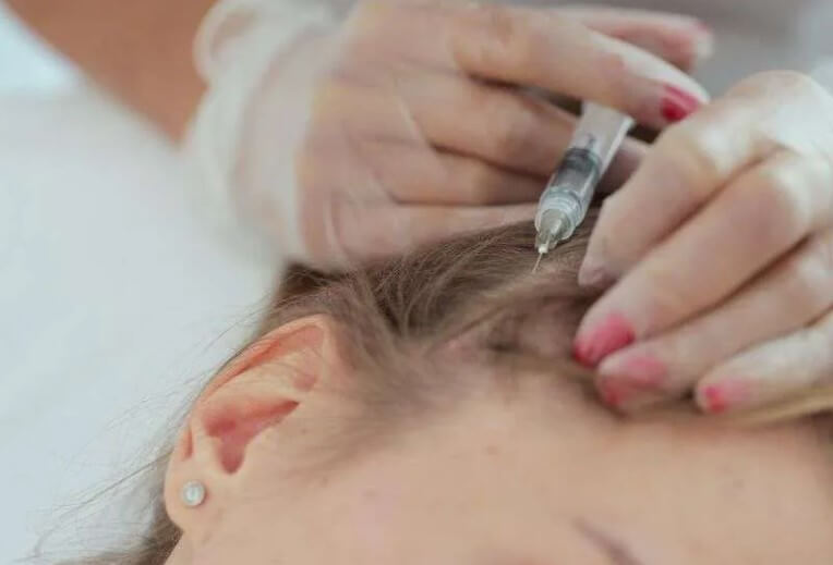 PRP hair treatment in Melbourne, FL Infuse Wellness